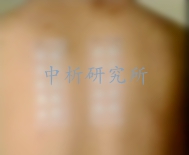 斑貼測(cè)試